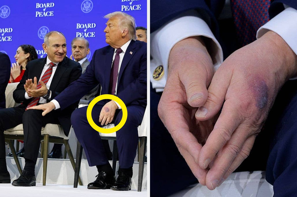 Politician in a suit, seated, gestures to another. A close-up shows bruised hands. Background has "Board Peace" text