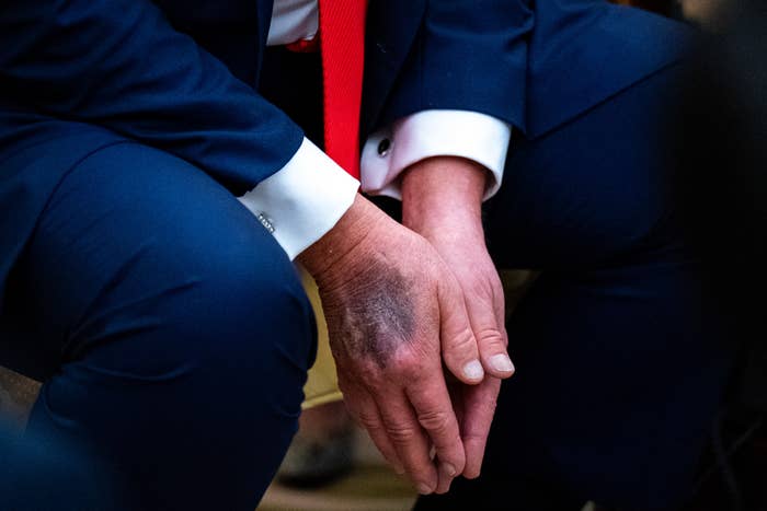 Person in a suit, with hands resting on knees, showing a noticeable bruise on one hand