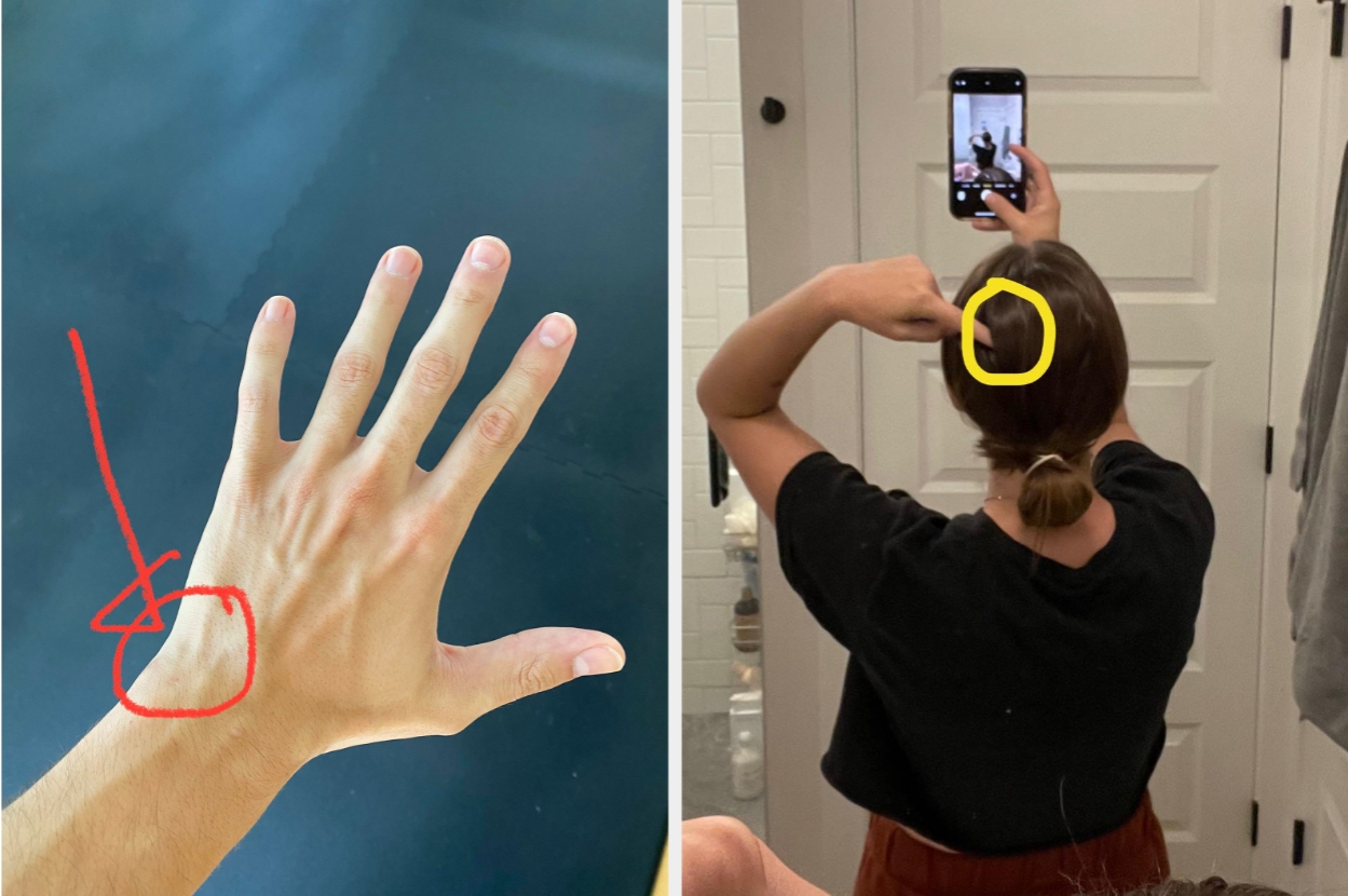 Two photos: Left, a hand with a red mark on the wrist. Right, a person in a bathroom mirror pointing at a small circle on their hair