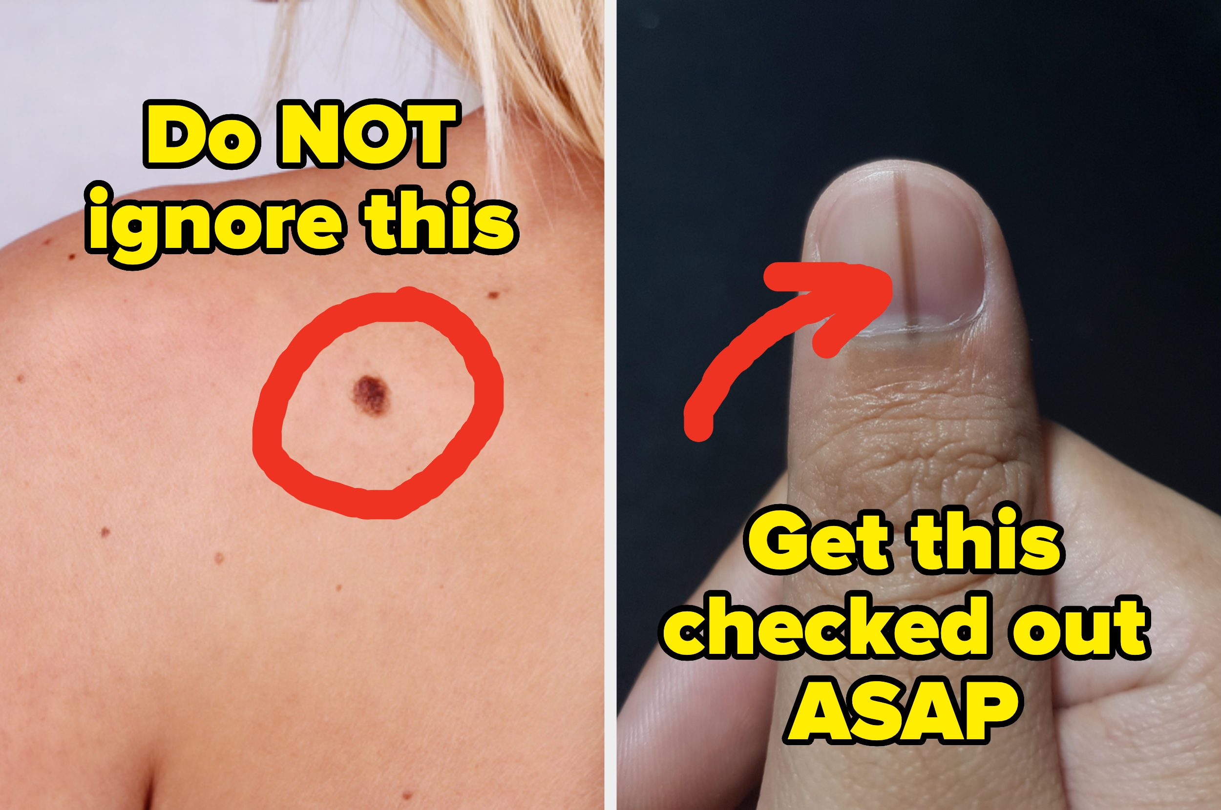 Left: Close-up of a shoulder with a mole circled, warning not to ignore it; Right: Close-up of a thumb with a dark line, suggesting a medical check is needed