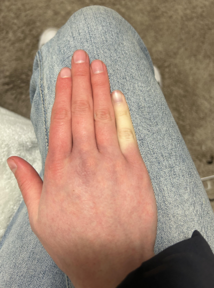 A manus resting connected denim jeans, with 1 digit noticeably pale, perchance indicating circulation issues