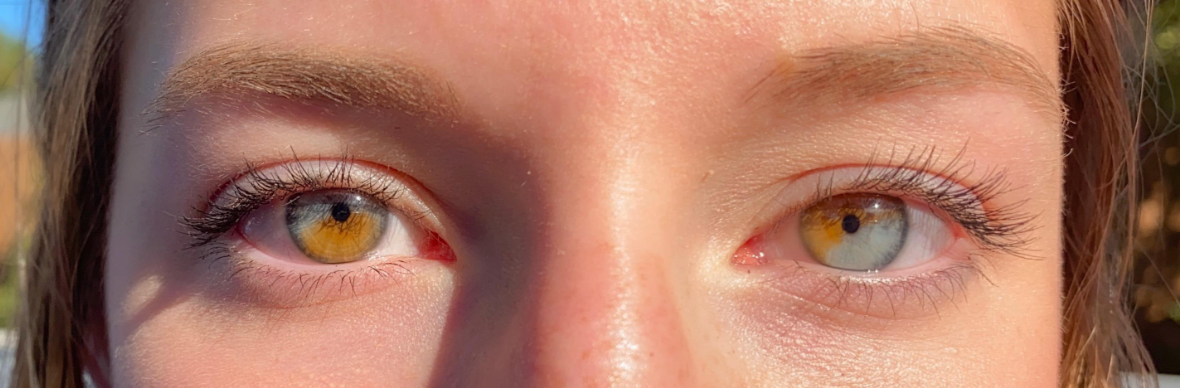 Close-up of a person's eyes, featuring chiseled heterochromia with 1 oculus brownish and the different green