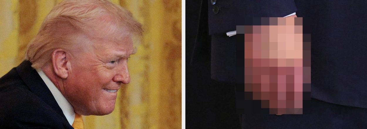 Trump's Hand Is Looking Veeeeery Purple, Even For Him