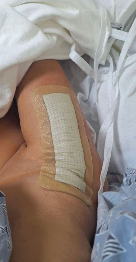 Leg with a ample bandage connected the knee, resting connected a infirmary bed. Hospital gown and sheets are visible
