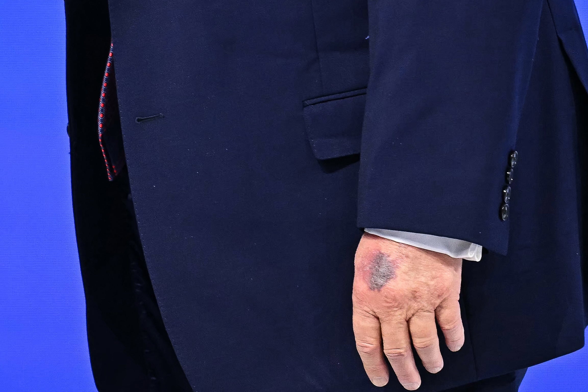 Tampilan dekat tangan kiri Donald Trump dengan memar kecil berwarna gelap
