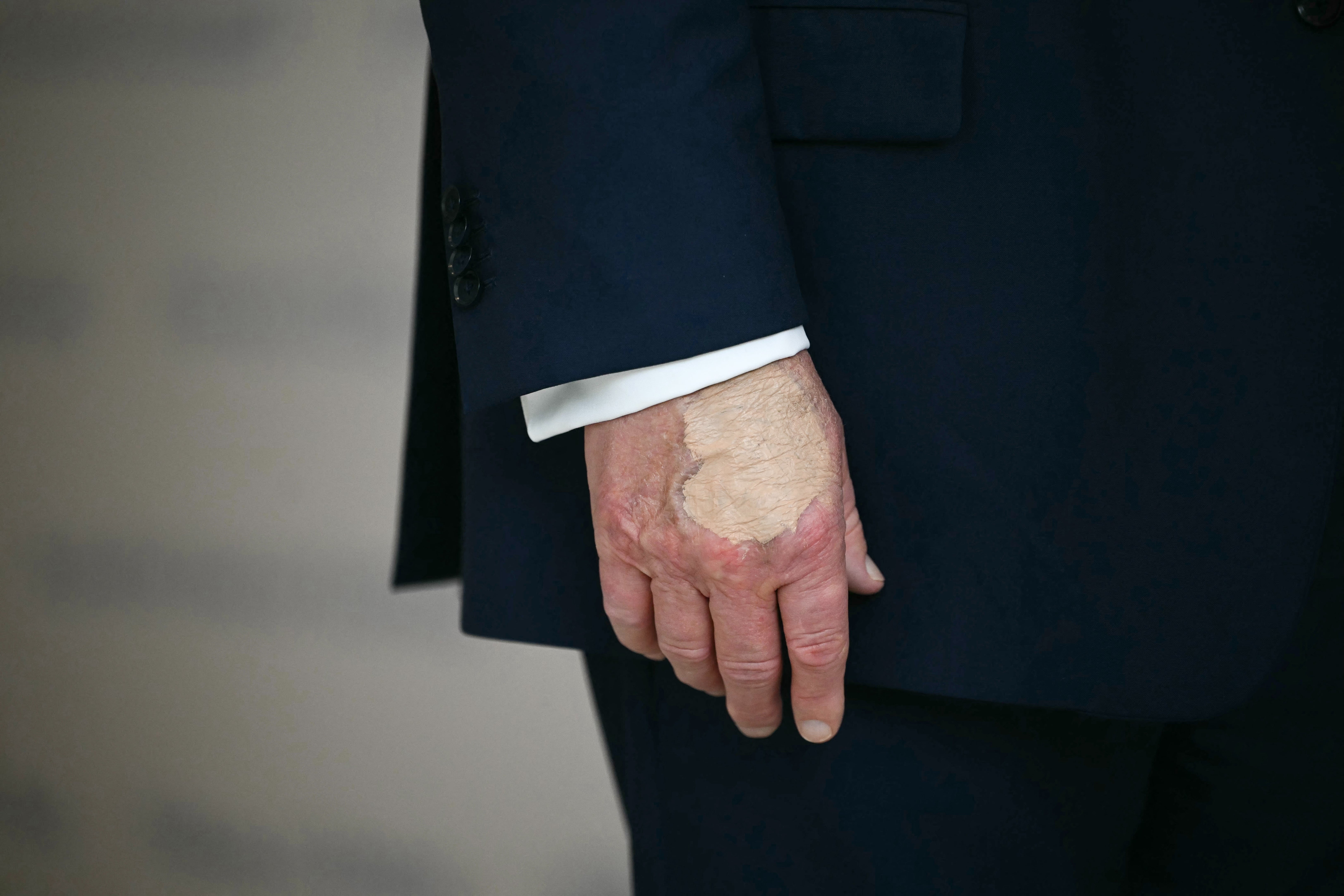 Tampilan dekat tangan kanan Donald Trump dengan concealer berwarna sangat cerah di atas memar yang disebutkan di atas