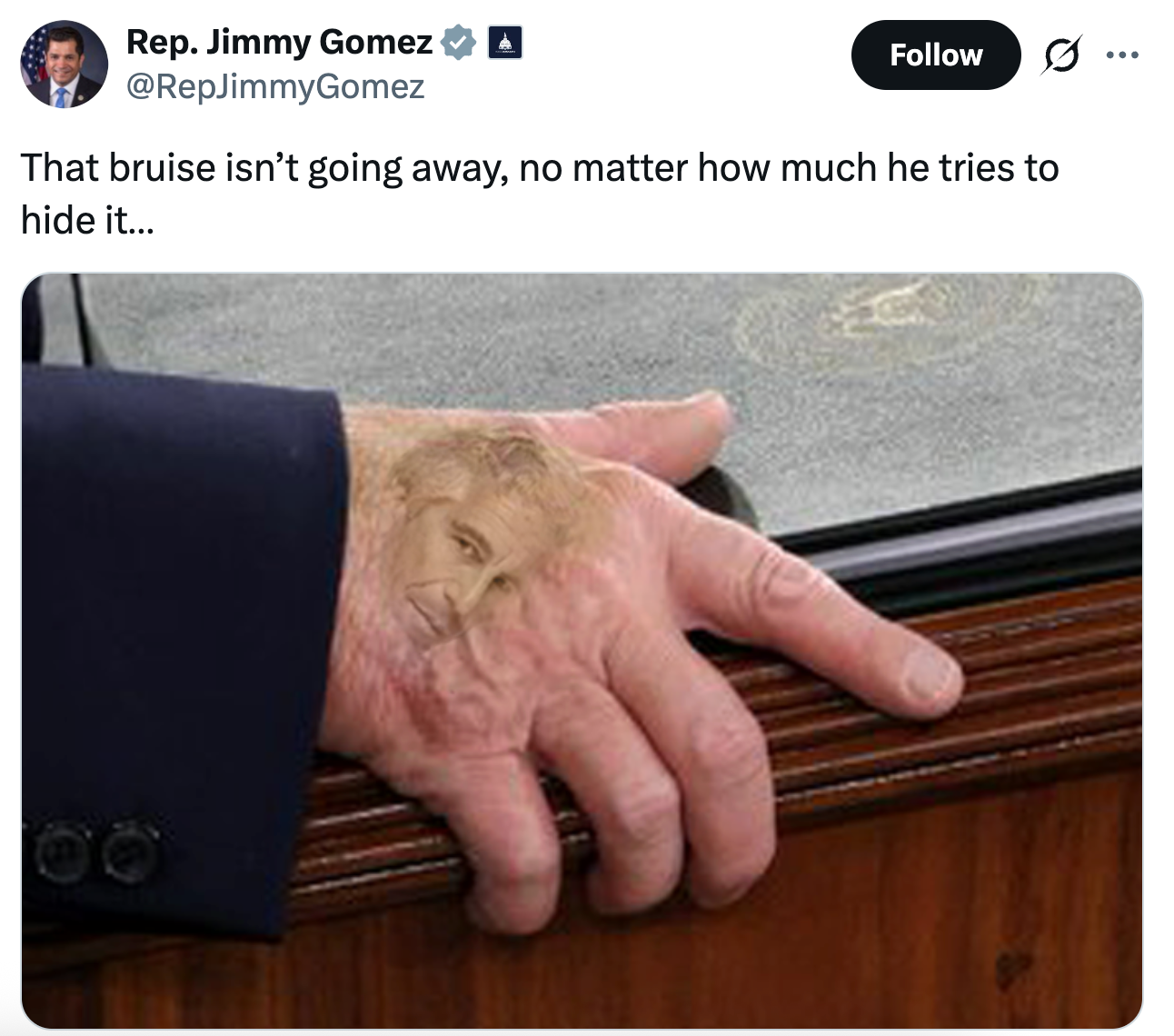 En hånd med et blåmerke med et overliggende ansikt hviler på en overflate. Tweeten over nevner det vedvarende blåmerket