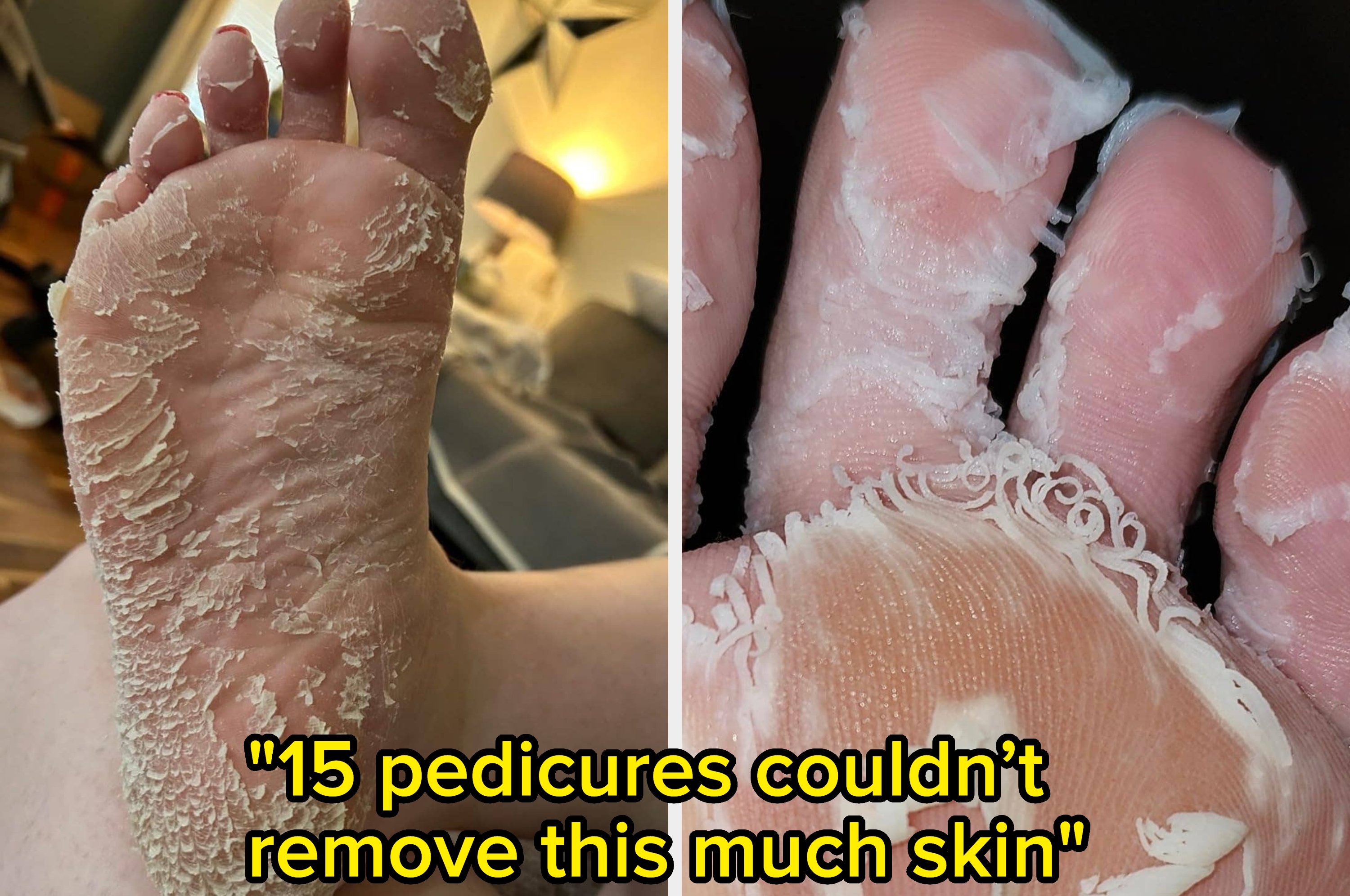 Close-up of a foot before and after a skin-peeling treatment, showing significant exfoliation