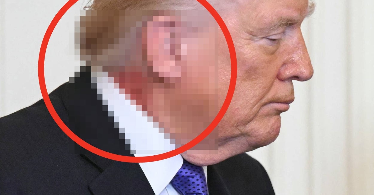 Donald Trump Has A Rash-Like Splotch On His Neck, And The Pic Is Reigniting Health Concerns