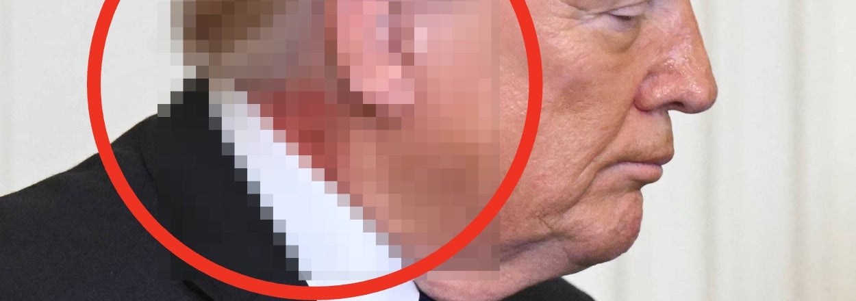 Donald Trump Has A Rash-Like Splotch On His Neck, And The Pic Is Reigniting Health Concerns