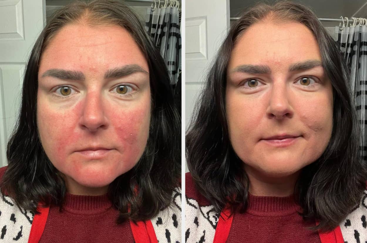 Before-and-after comparison of a woman's face showing skincare improvement, with less redness and smoother complexion in the after image