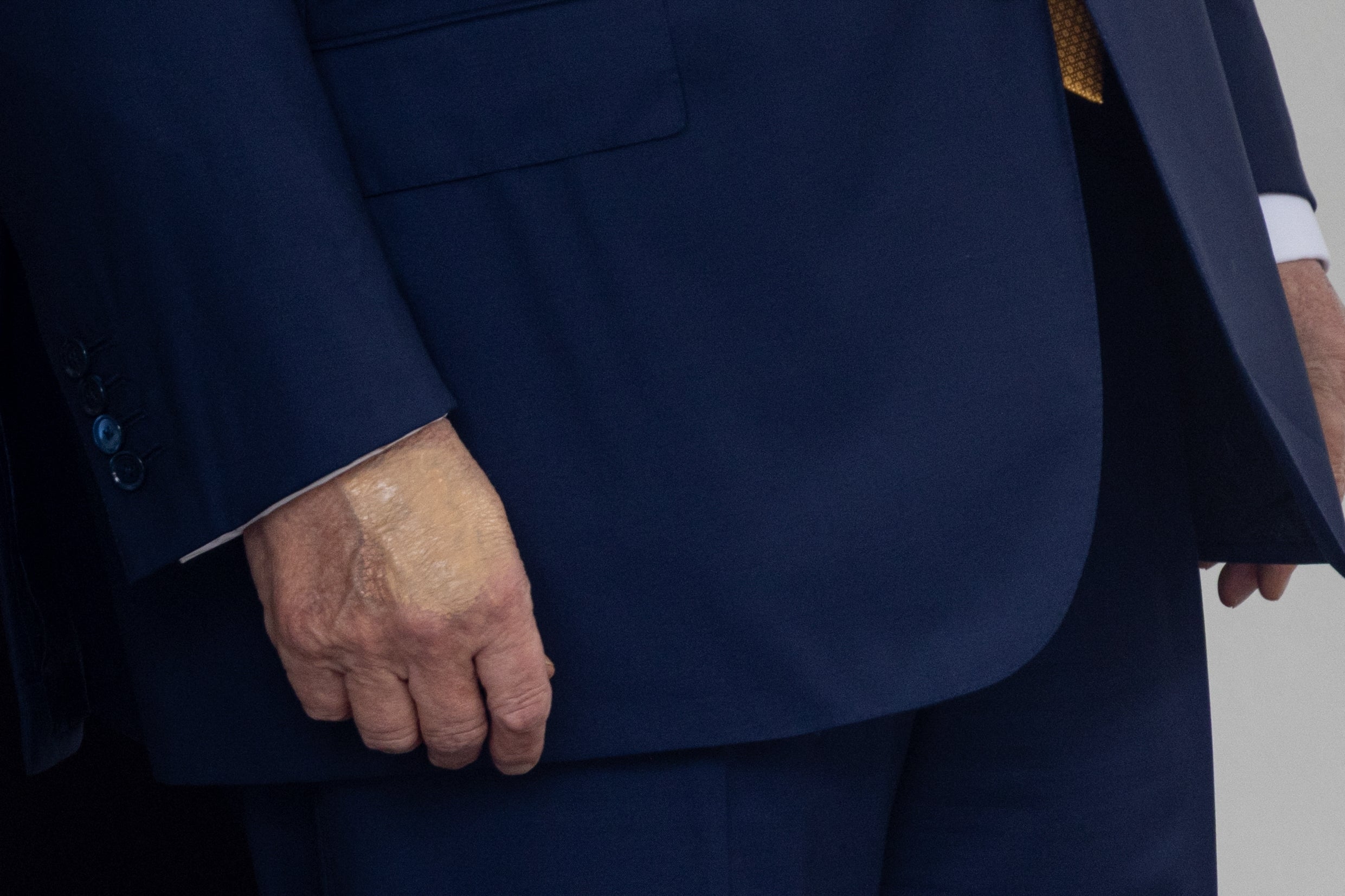 Nærbilde av en person i en formell dress med hånden synlig, som viser en hudtilstand