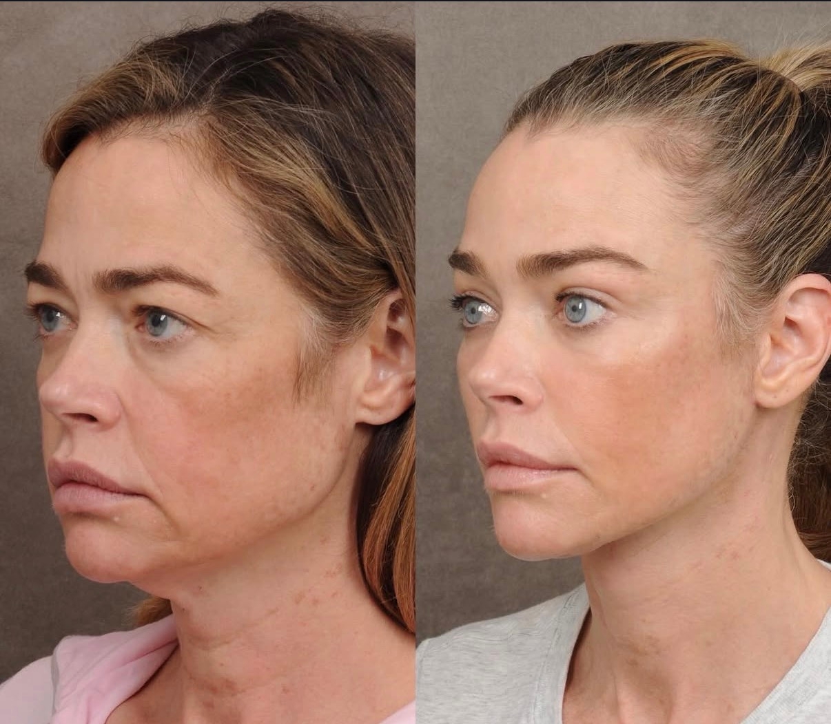 Denise Richards with a noticeable facial translation with smoother tegument and enhanced features aft a facelift