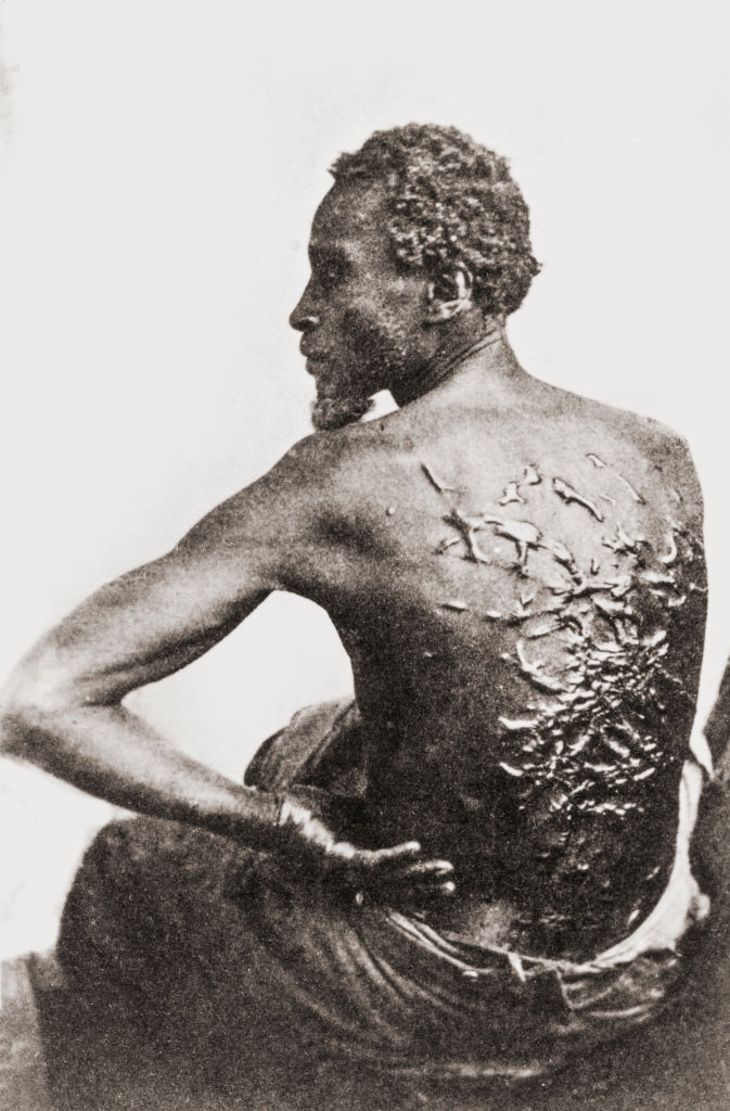 Historic photograph of an African American antheral showing extended scarring connected his backmost from whippings during slavery, highlighting past injustices