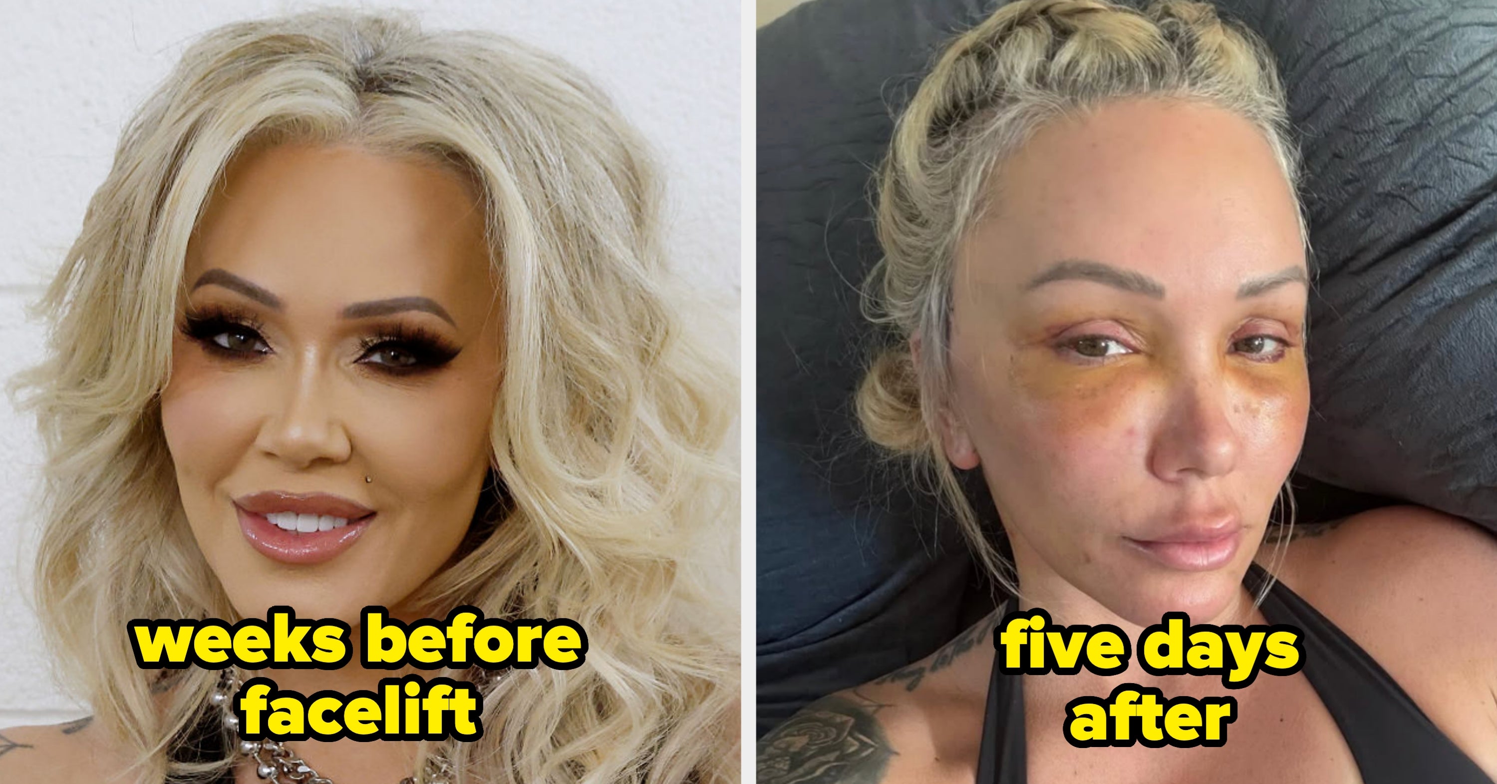 16 Celebs Who Admitted To Getting Facelifts (And How They Look Now)