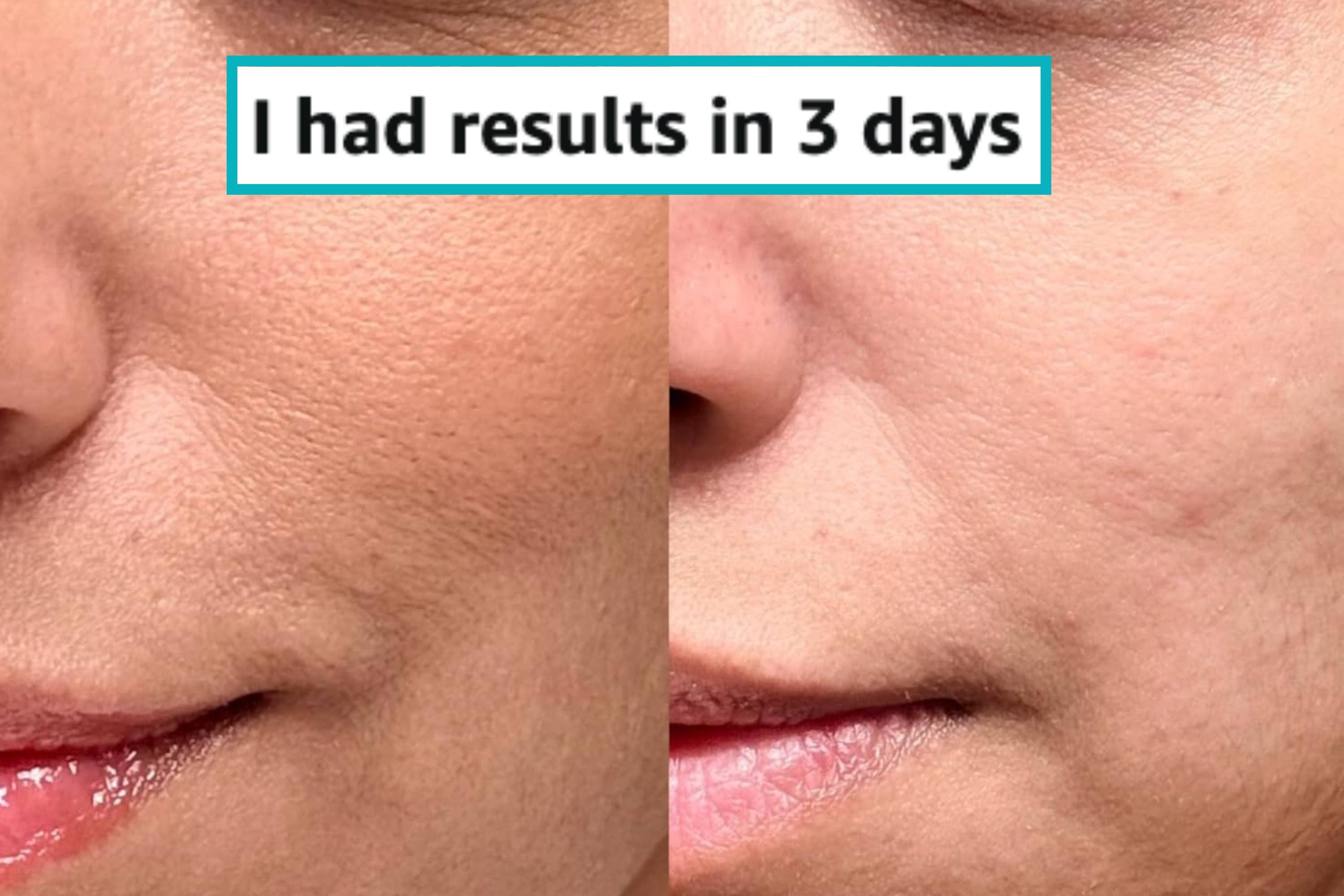 Close-up of a person's skin before and after using a skincare product, showing smoother texture. Text: "I had results in 3 days."