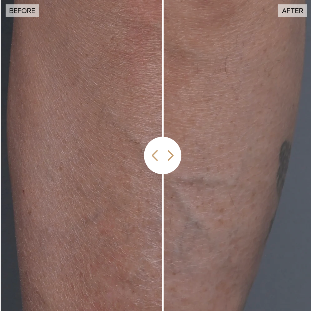 Side-by-side examination  of tegument  earlier  and aft  treatment, showing disposable   betterment  successful  texture and tone