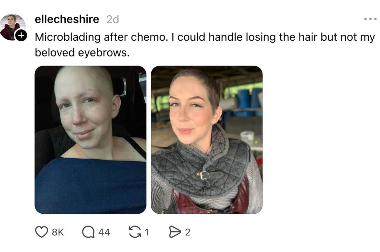 Two side-by-side photos of a person after chemotherapy show a bald head in one and styled hair with microbladed eyebrows in the other