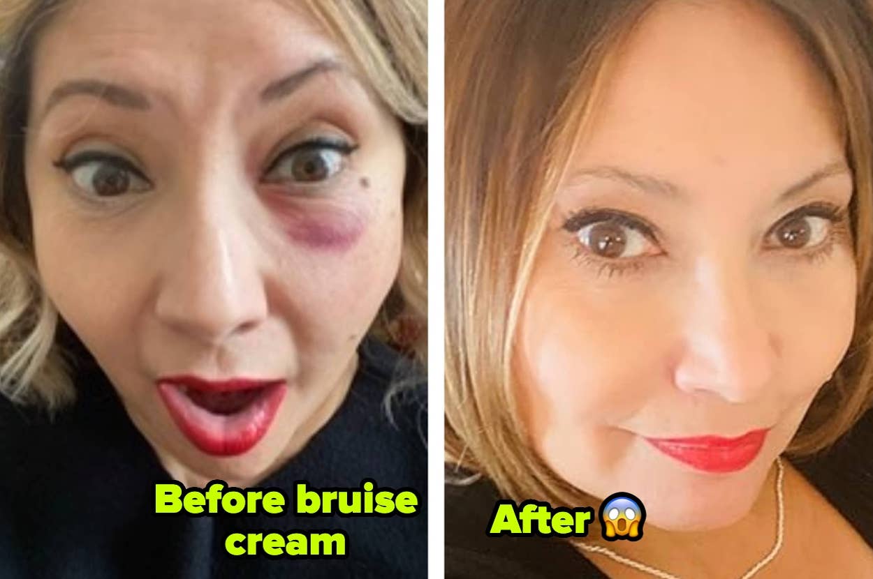 Split image showing a person's face before and after using bruise cream; the bruise is visibly reduced in the "after" image
