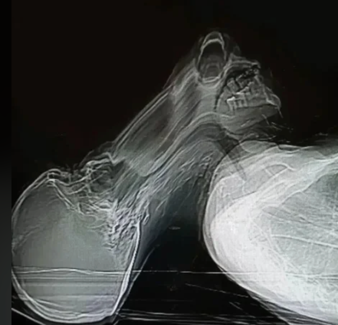 X-ray representation showing 2 skulls positioned back-to-back, highlighting their bony structures
