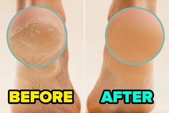 Before and after photos showing the transformation of a dry, cracked heel to smooth skin. Labels read "BEFORE" and "AFTER."