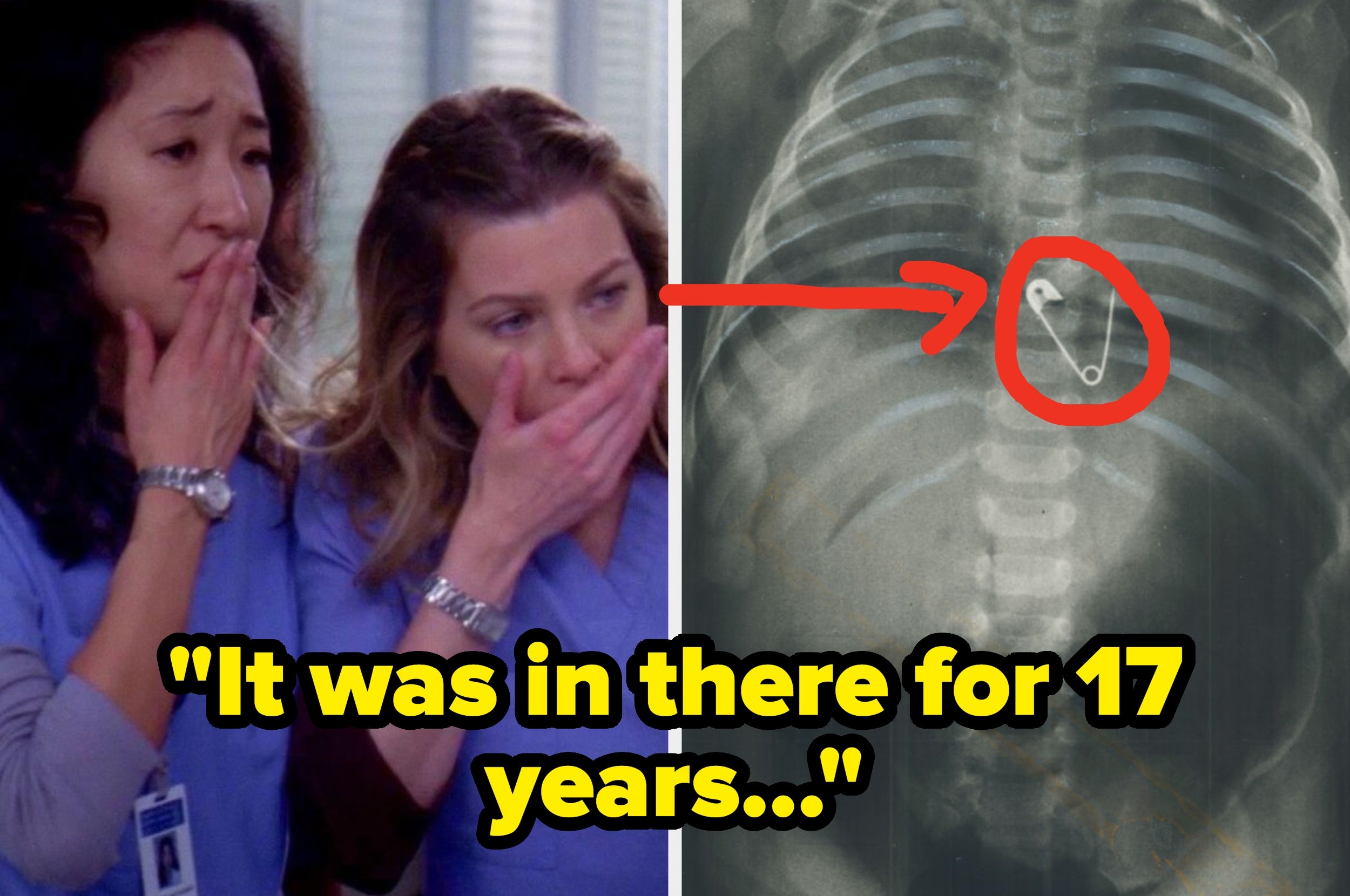 Two people in scrubs look shocked at an X-ray showing a pin inside a ribcage. Text says, "It was in there for 17 years..."