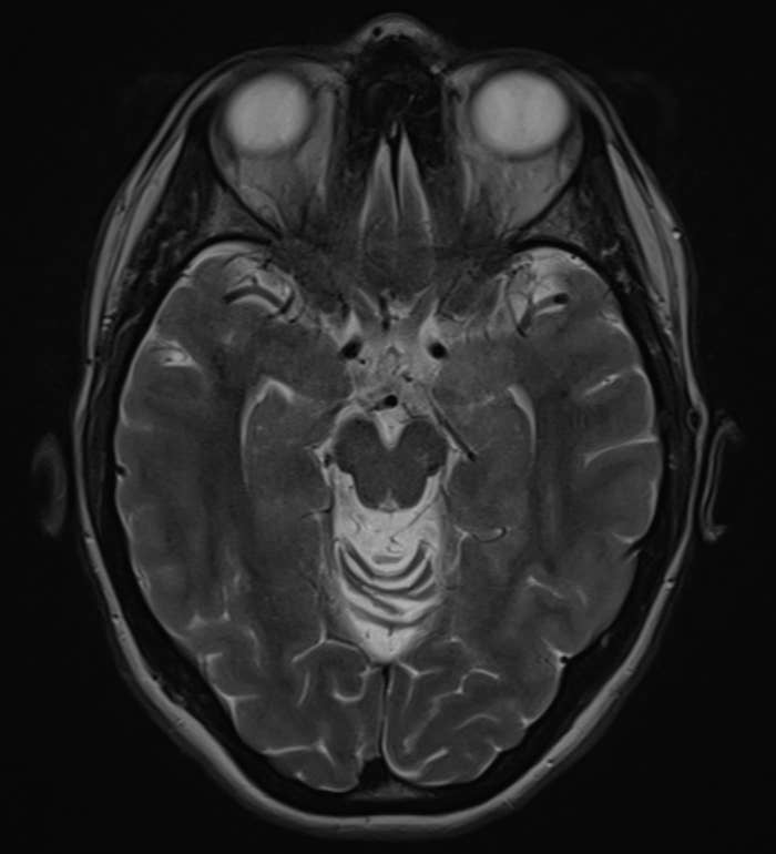 MRI scan showing a cross-section of a quality  brain