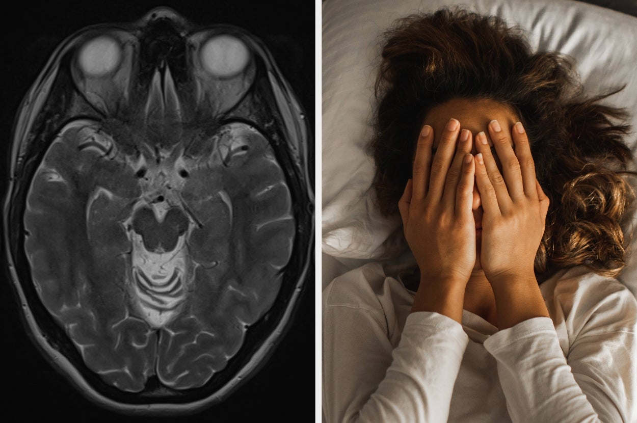 MRI brain scan and a person lying in bed with hands covering face, suggesting stress or anxiety