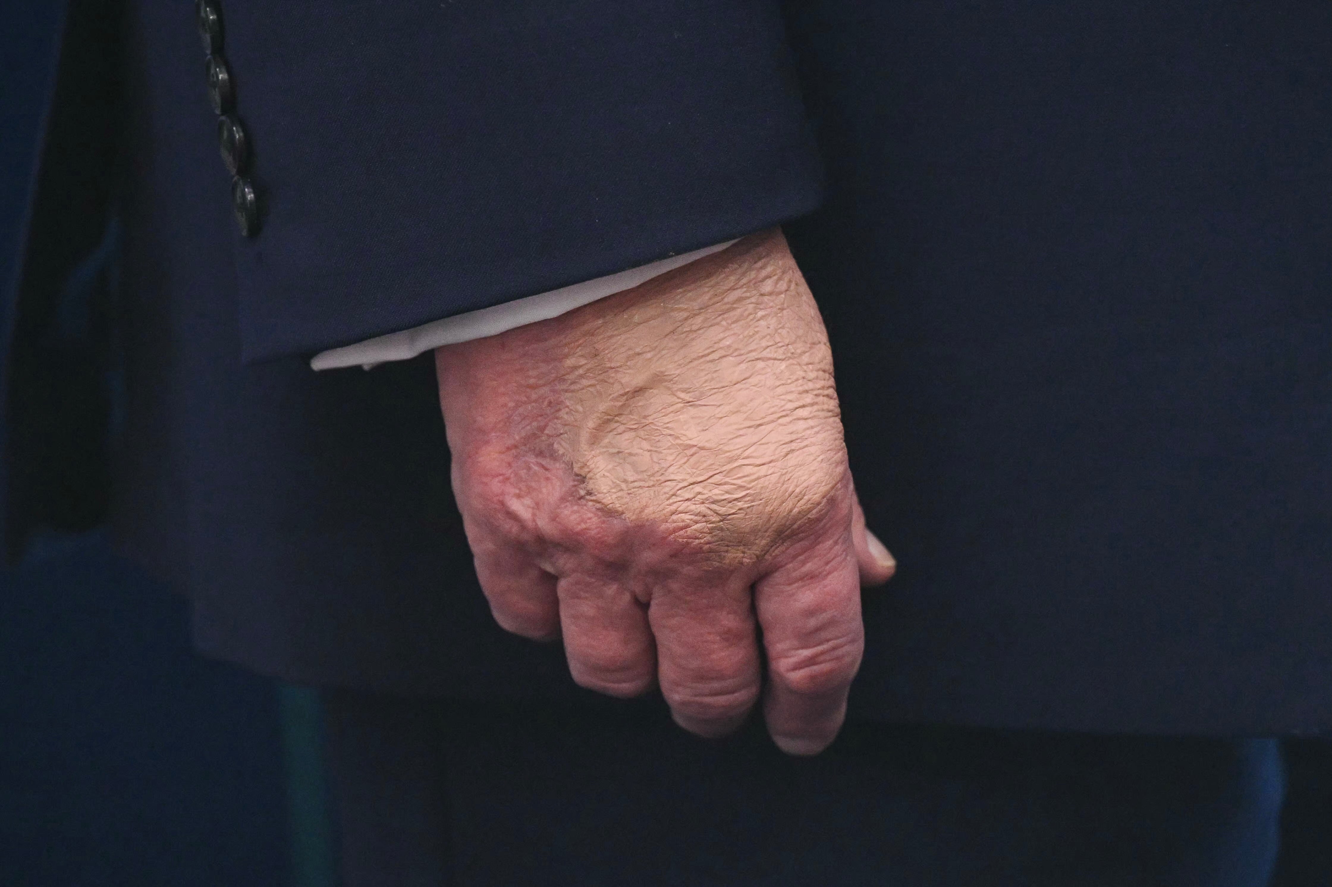 Et nærbilde av en persons hånd, som viser detaljert hudtekstur og små tegn på aldring. Personen har på seg mørk dress