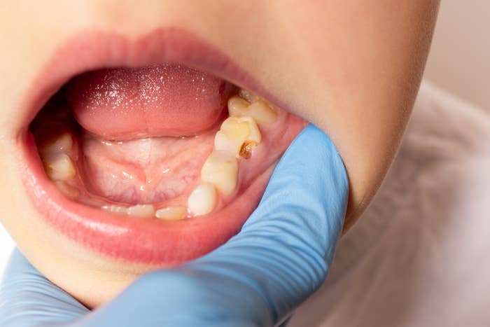Child with unfastened  rima  showing decayed teeth, examined by a gloved dental professional, highlighting dental wellness  issues successful  children