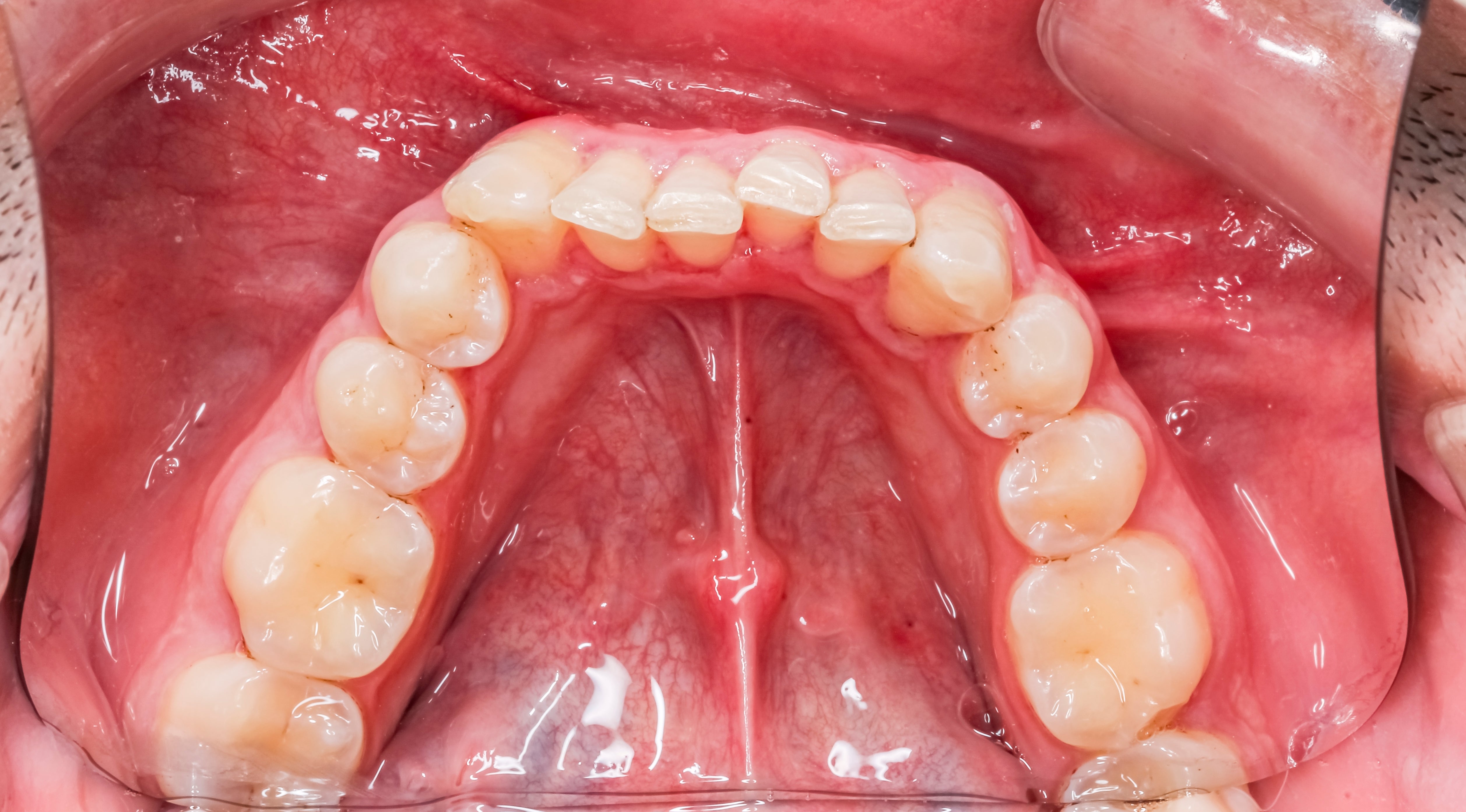 Close-up presumption    of a person's precocious    dental arch, showing teeth and gums, for an nonfiction  connected  oral health