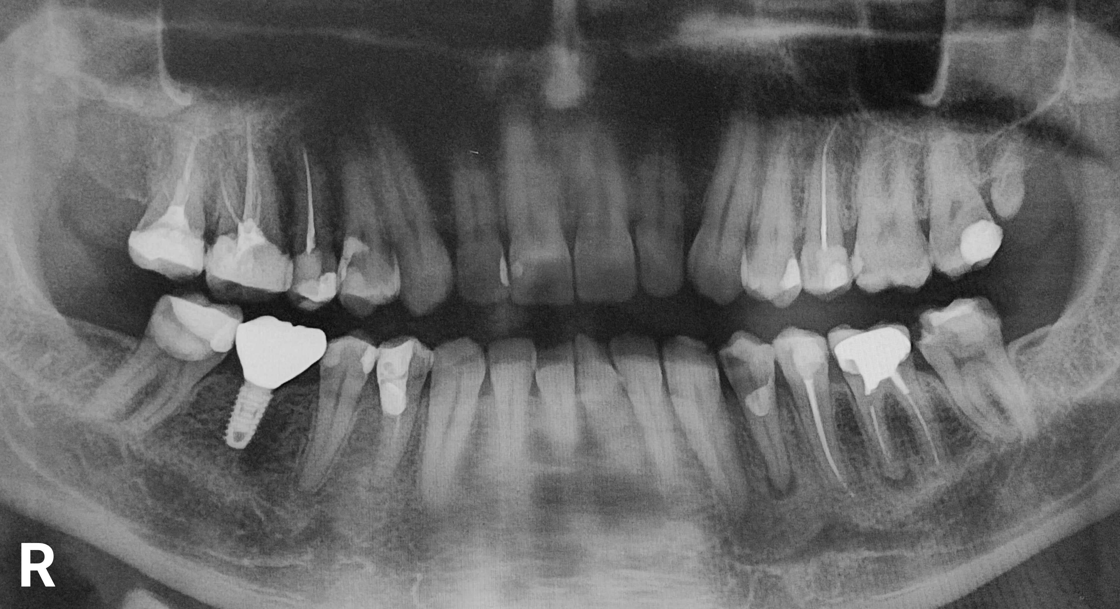 Dental X-ray showing teeth with fillings and imaginable  dental implants connected  the near  and right