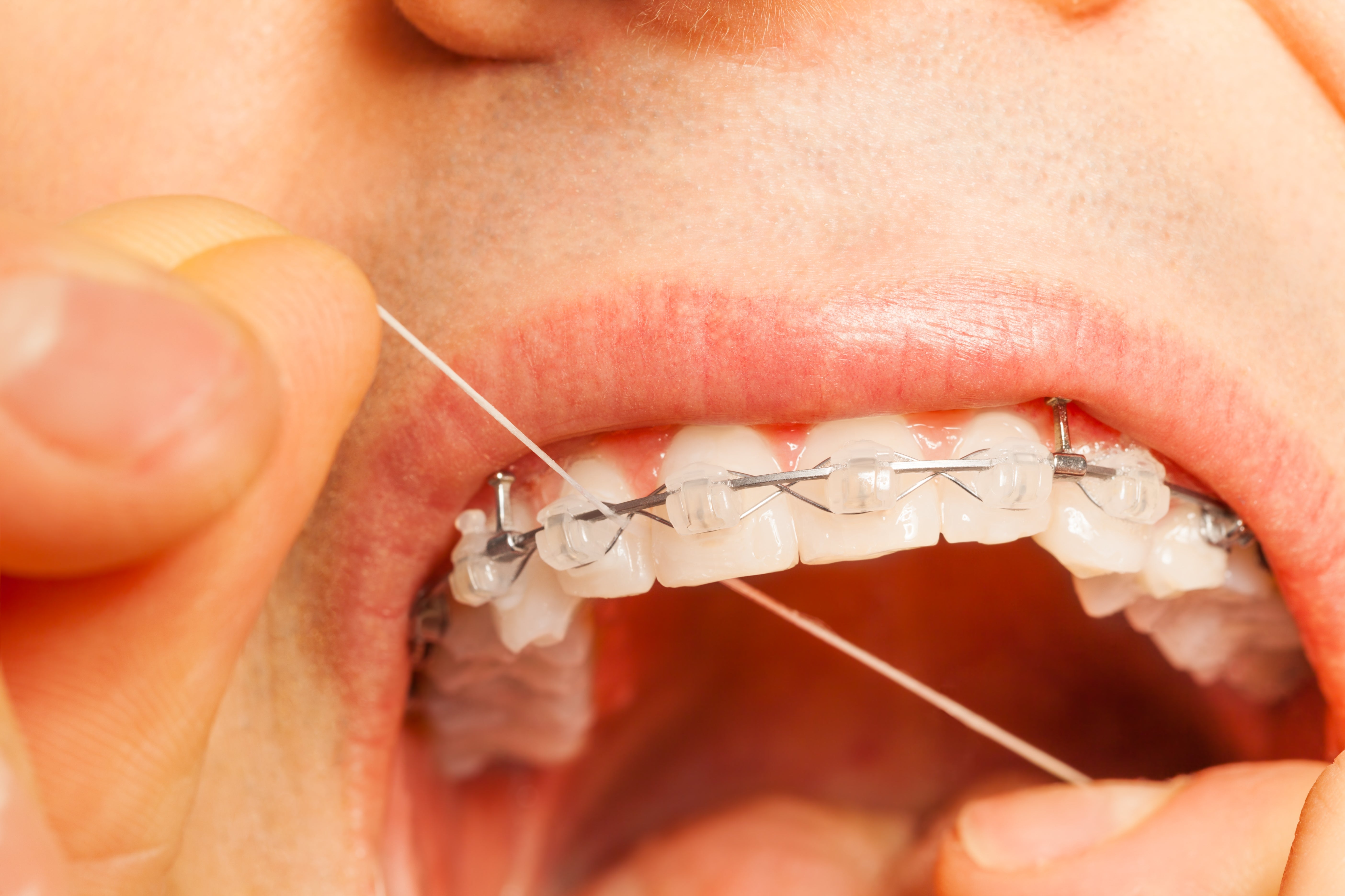 Person flossing teeth with braces, demonstrating oral hygiene maintenance