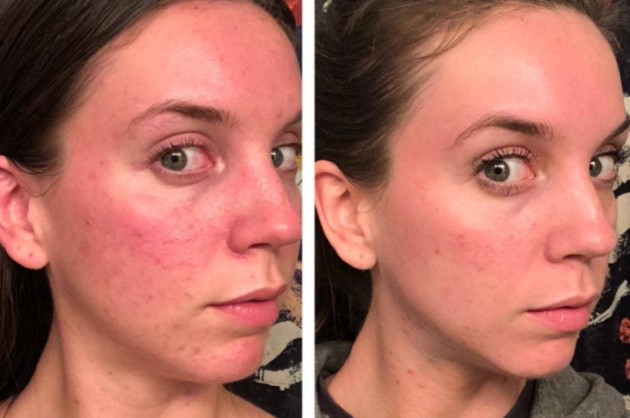 Before and after comparison of a woman's face showing reduced redness and smoother skin texture