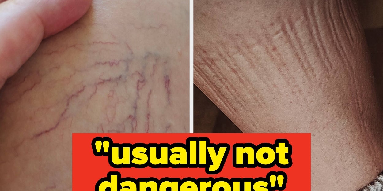 When Sock Indentations Signal Health Problems