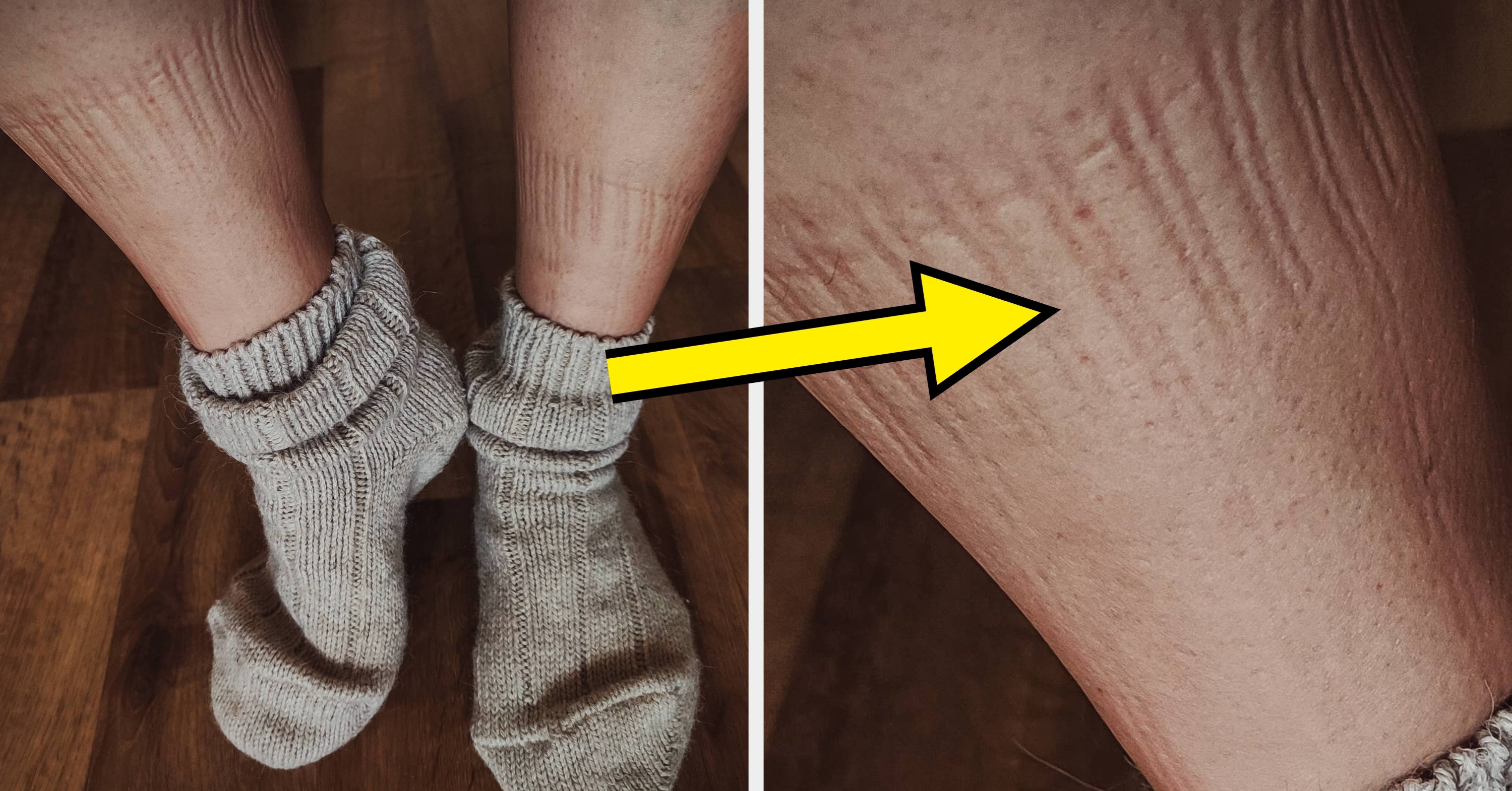 Here's What It Means If Your Socks Leave Marks On Your Legs, And When To Be Concerned