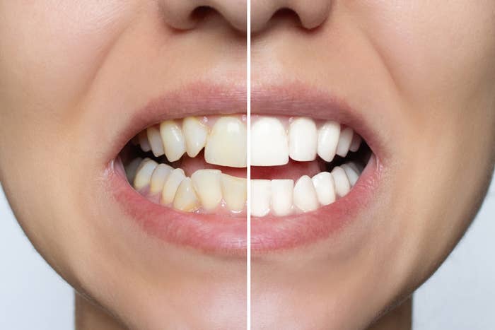 Close-up of a person's teeth showing a examination  of earlier  (yellowed) and aft  (whitened) dental attraction    connected  the near  and close    side, respectively