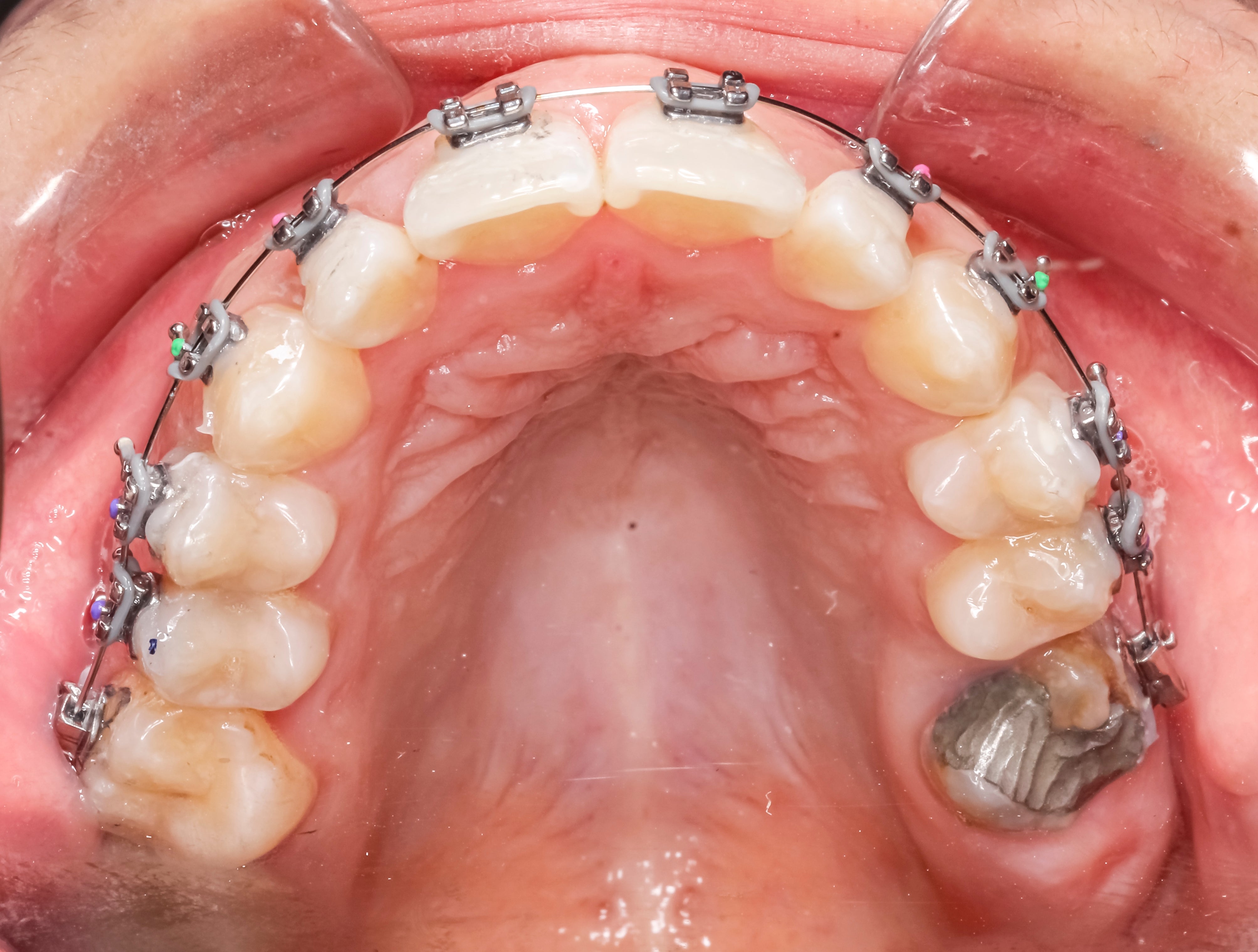 Close-up of a person's precocious    teeth with metallic  braces, showing oral orthodontic attraction    and a dental filling connected  a molar