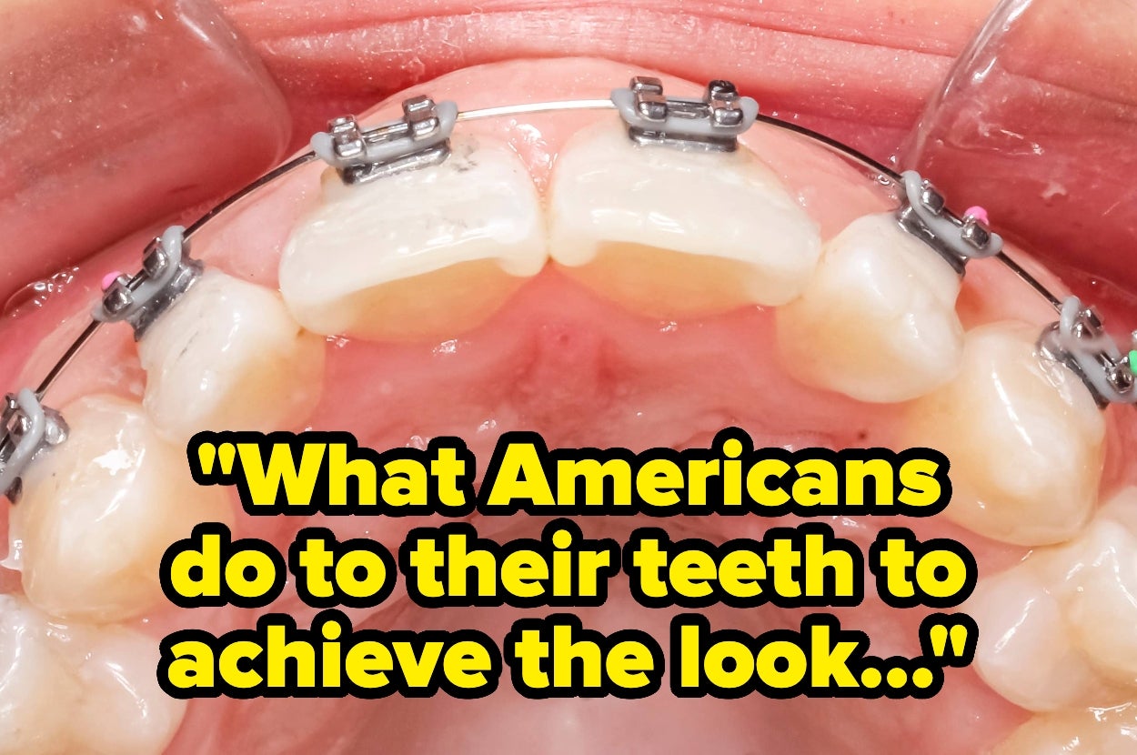 Braces on teeth with text: "What Americans do to their teeth to achieve the look..."