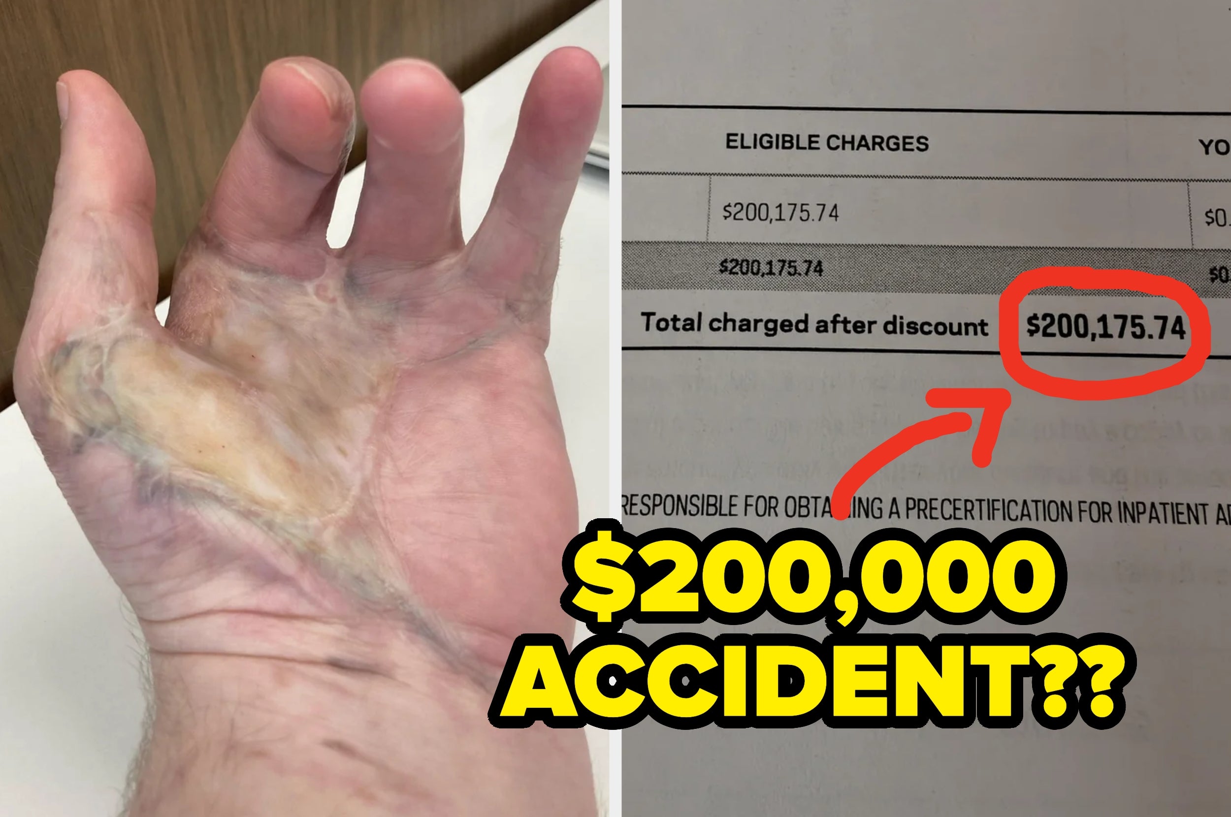 A hand with a burn scar; linked to a bill showing a $200,175.74 charge highlighted for an accident. Text reads: "$200,000 accident??"