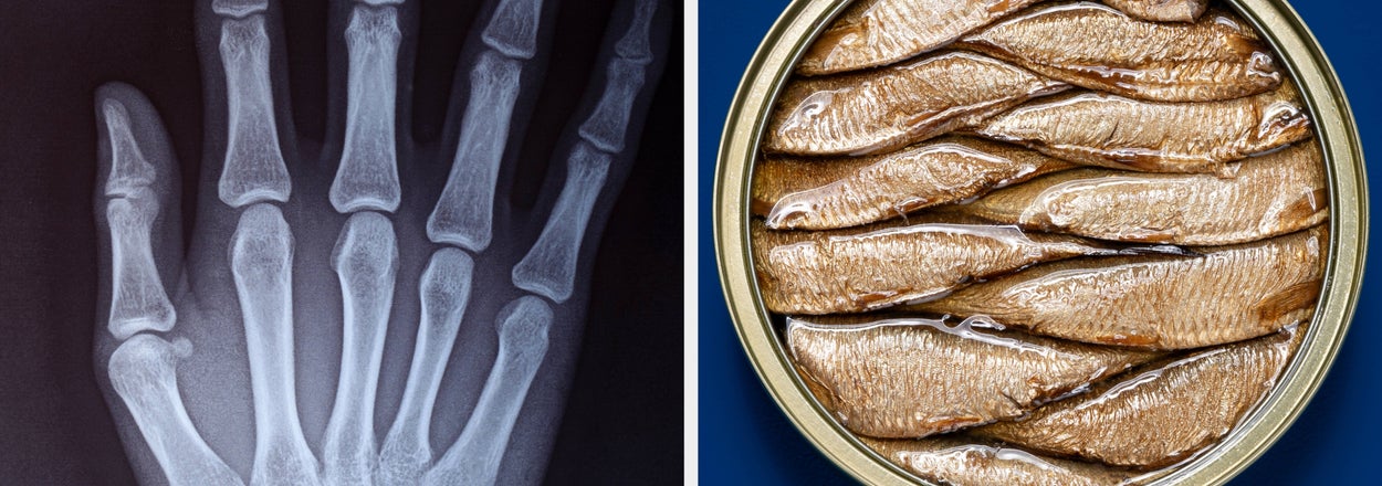 Osteoperosis "Is Largely Preventable," According To Bone Health Experts. Here's How To Avoid It