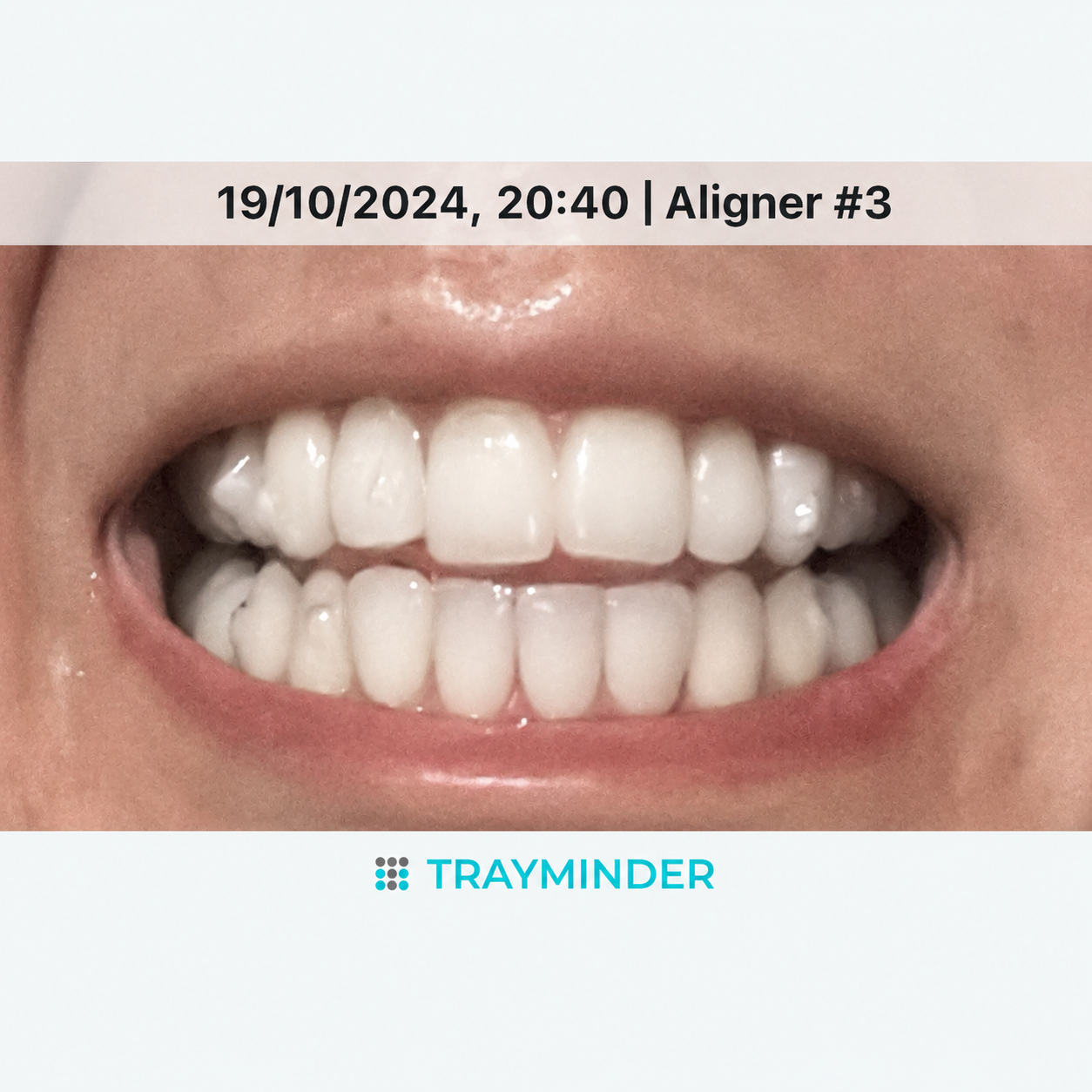 Invisalign: Everything You Need To Know