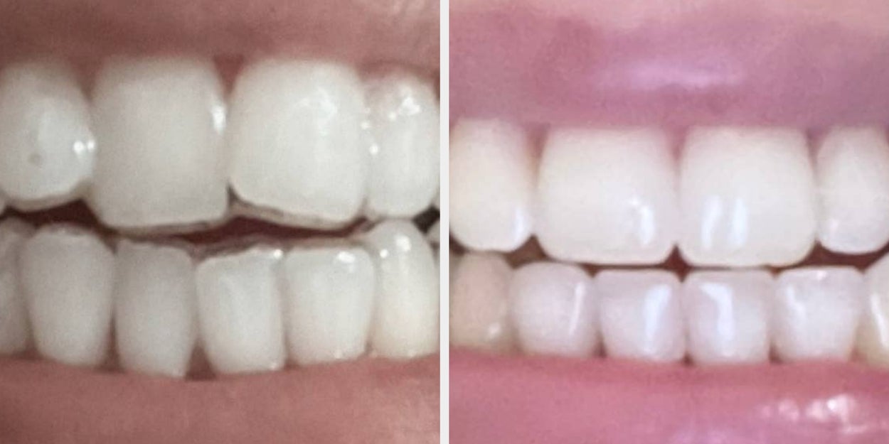 Invisalign: Everything You Need To Know