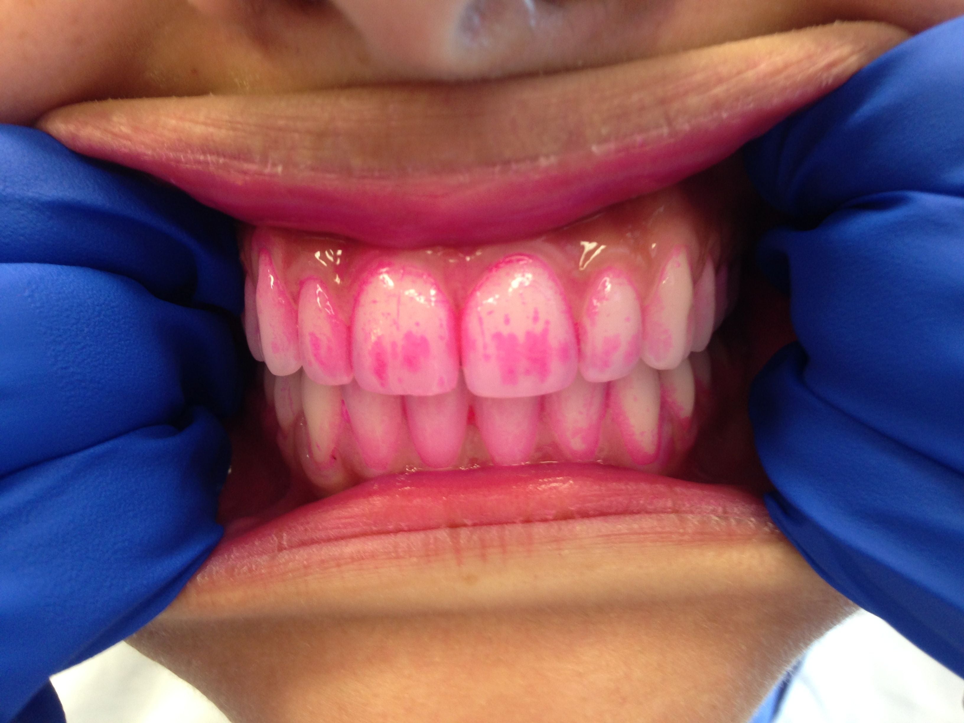 Close-up of a person's teeth showing plaque staining, held open by gloved hands
