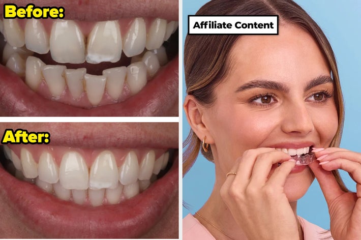 Dental before-and-after images with a woman using a teeth aligner, captioned "Affiliate Content."