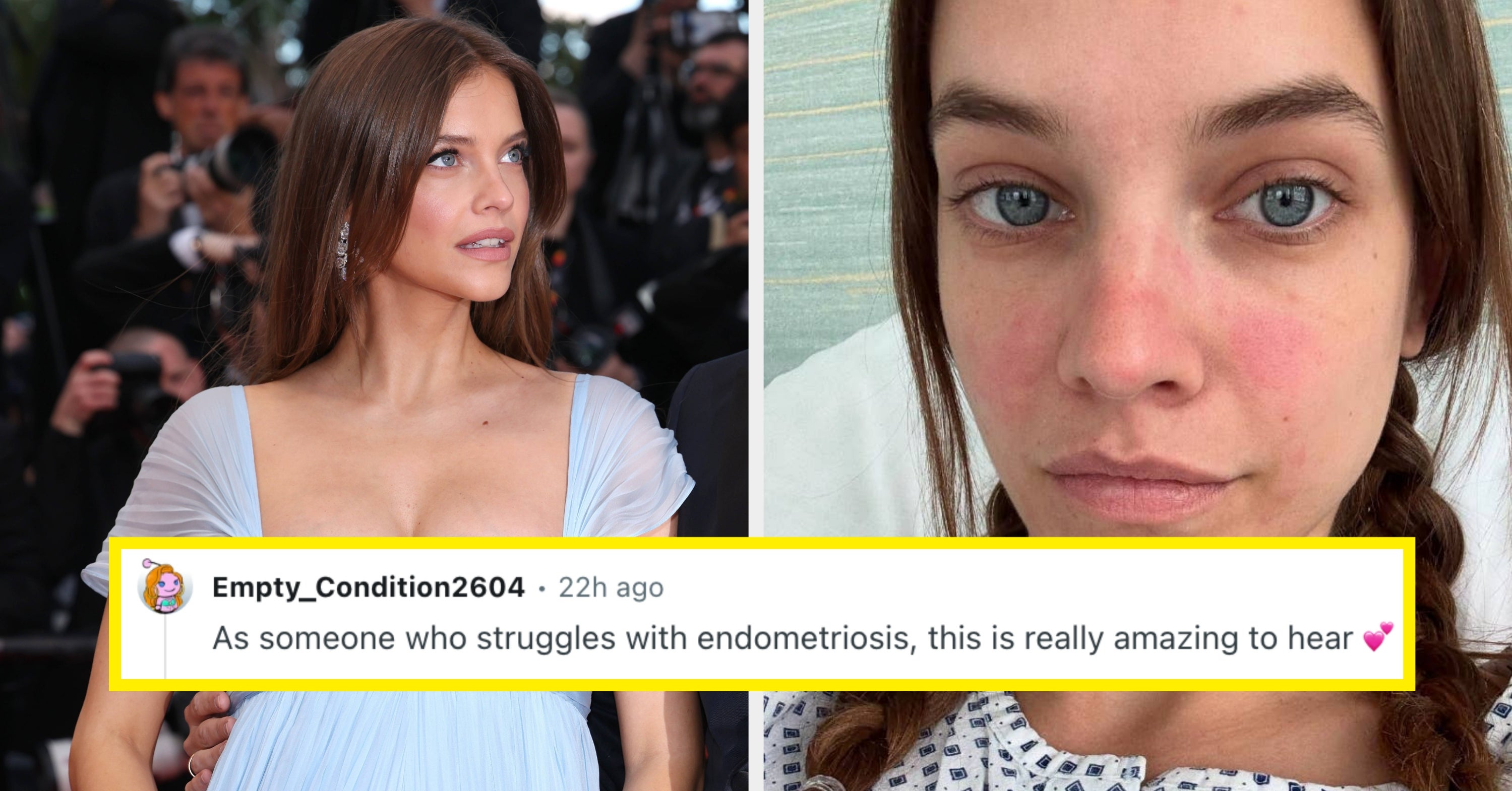 Barbara Palvin’s Endometriosis Experience Makes Her Pregnancy News All The More Special, So Here’s Everything You...