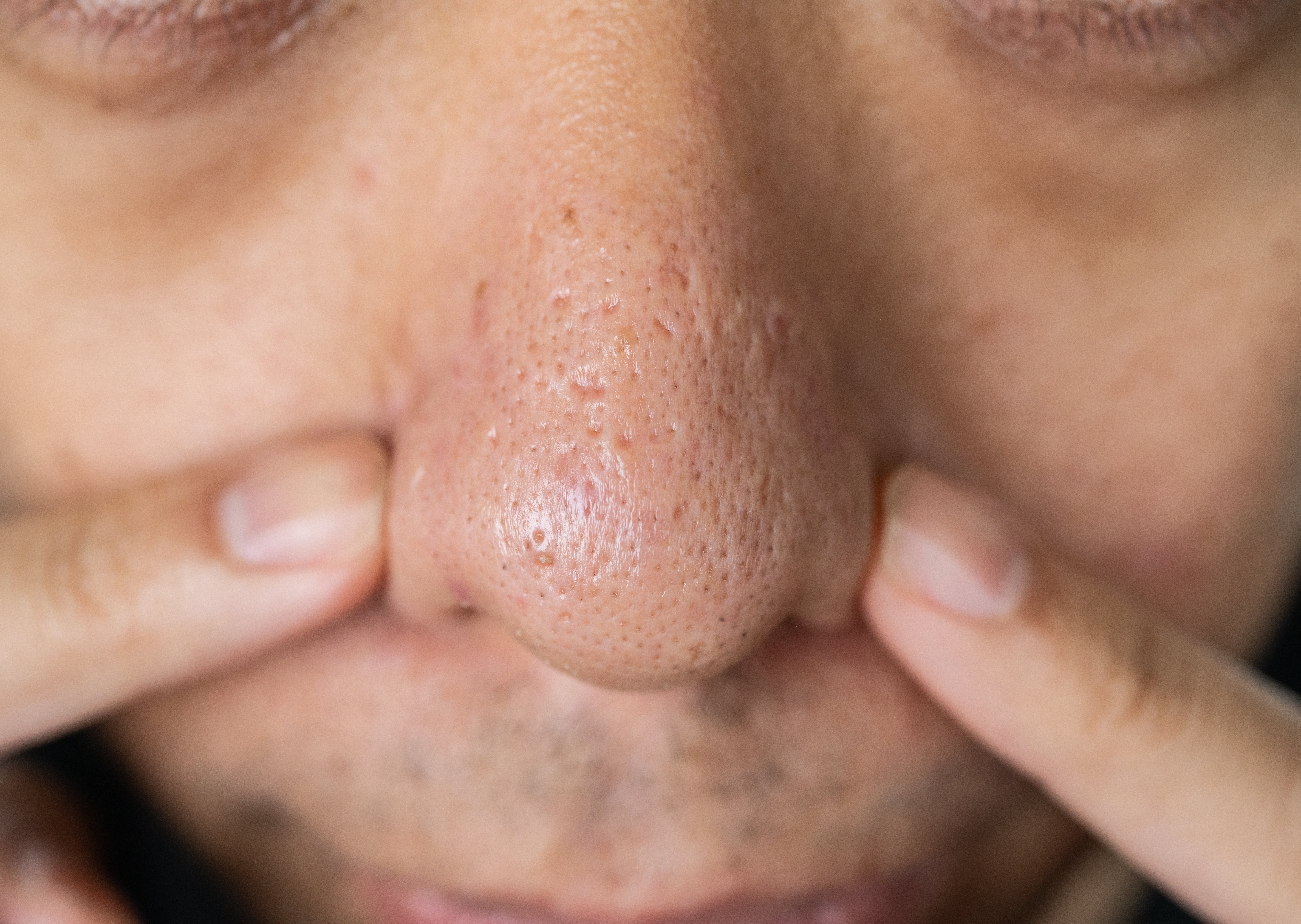 Close-up of a person's chemoreceptor with disposable pores, showing fingers mildly pressing connected the sides