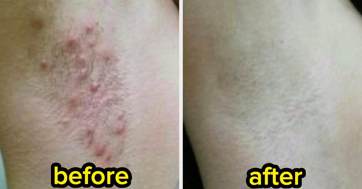 20 Things That Helped Reviewers With Ingrown Hairs