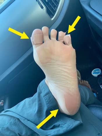 Foot with bandaged toes resting successful a car interior