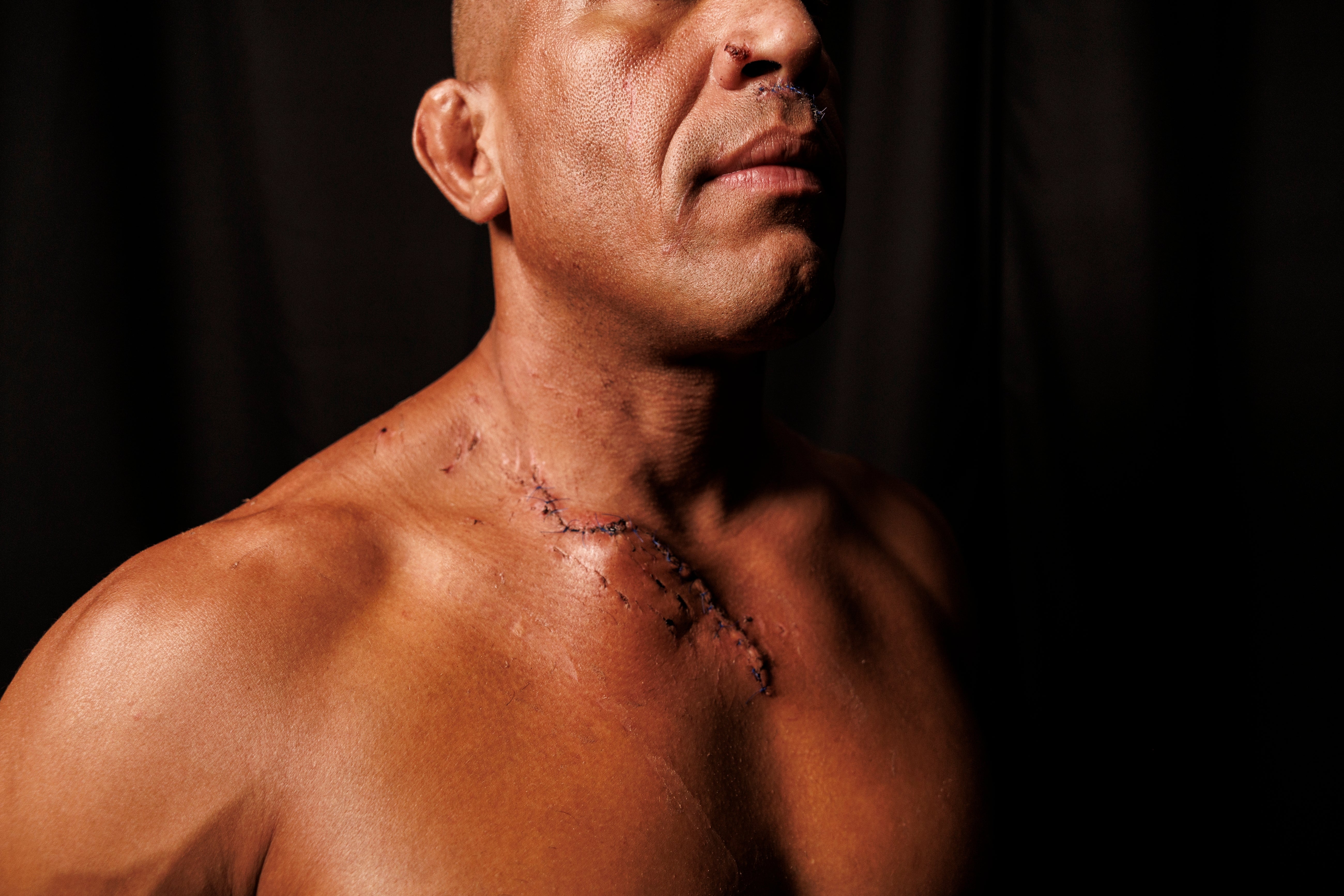 A idiosyncratic showing a healing surgical scar connected their cervix and precocious torso against a acheronian background